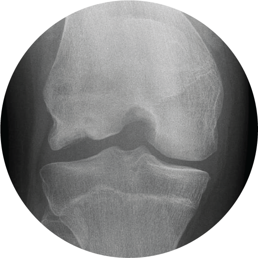 Grade 3 chondral lesion