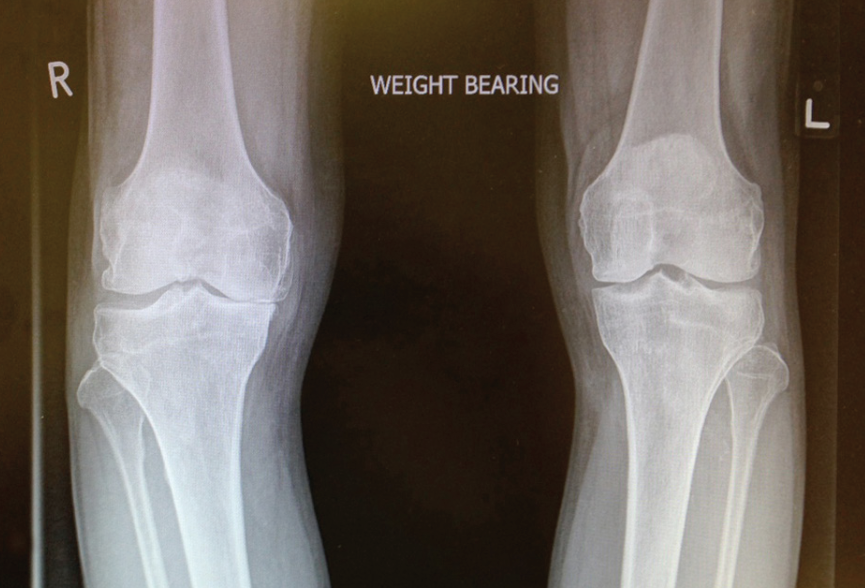 Medial compartment OA right knee
